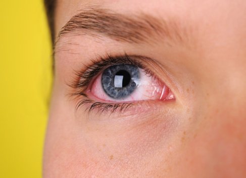 10 Reasons Your Eyes Are Bloodshot pics images 10 Reasons Your Eyes Are Bloodshot