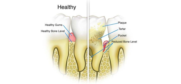 Home Remedies To Remove Tartar