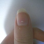 white spots on fingernail
