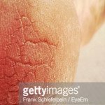 Tips tp cure Cracked Heels and Feet