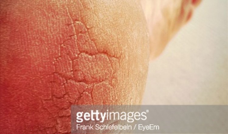 Tips tp cure Cracked Heels and Feet