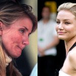 cameron diaz face pimple scars